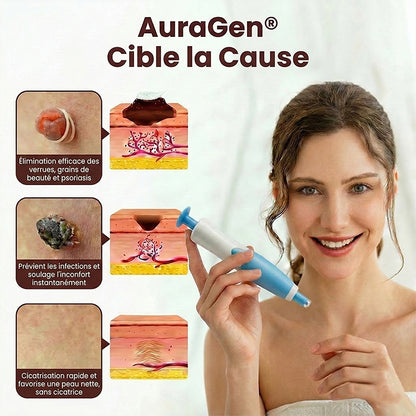 AuraGen® Stylo à double embout pour l'élimination des verrues