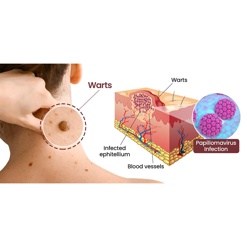 AuraGen® Skin wart removal pen（fr）